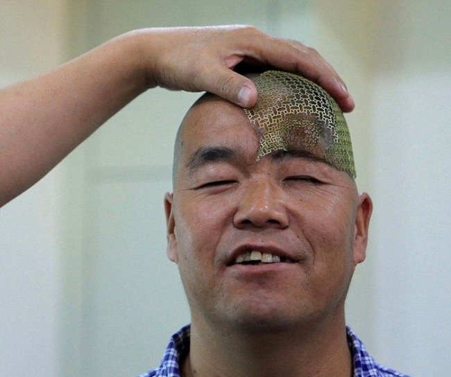 Врачи распечатали китайскому фермеру новый череп