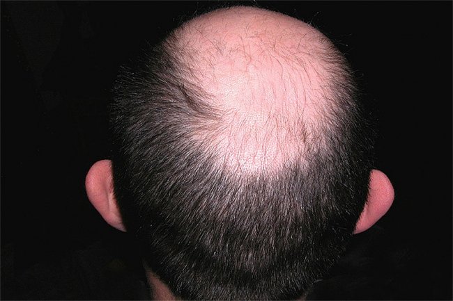 Что влияет на выпадение волос?